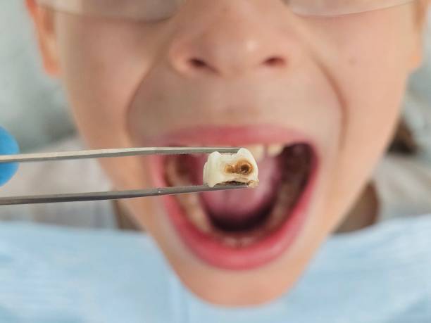 Best Emergency Tooth Extraction in Four Square Mile, CO